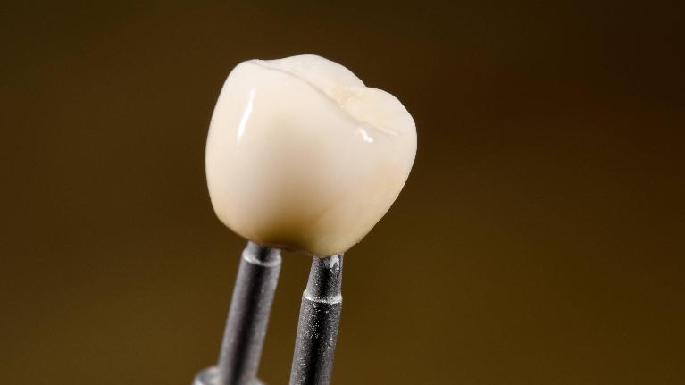 Dental Crown | Scott Stephens Dentistry