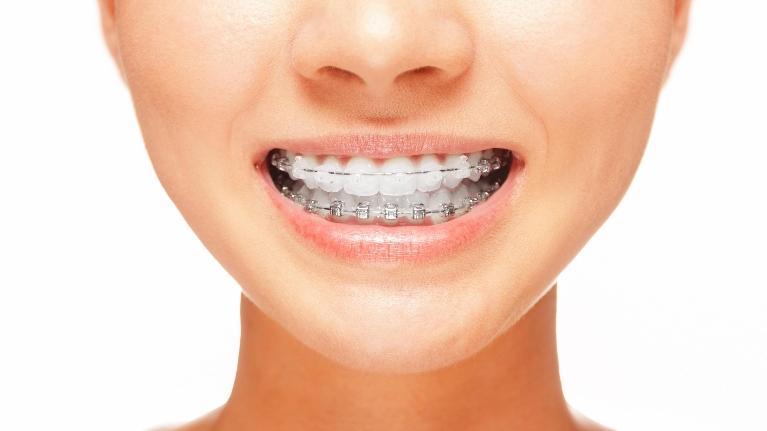 Post Orthodontic Care Blog | Fayetteville AR